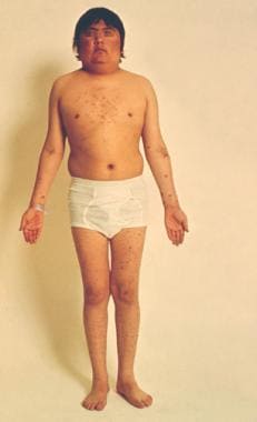 gigantism in children symptoms