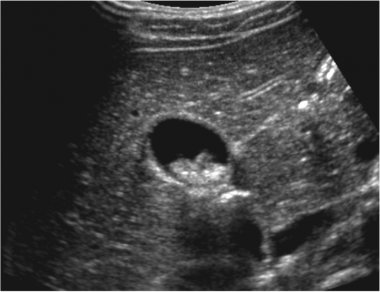 Pediatric Gallstones (Cholelithiasis). Transverse 