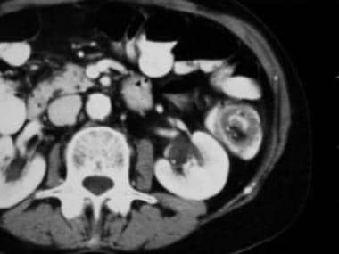 CT scan reveals the classic ying-yang sign of an i
