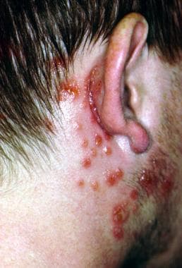 Pediatric Herpes Simplex Virus Infection Clinical Presentation