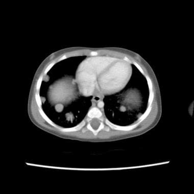 CT scan of child with a stage IV Wilms tumor with 