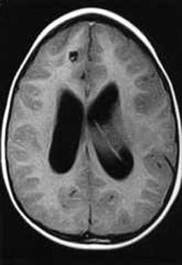 Axial image MRI of same patient as in Media file 2