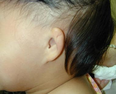 Microtia, grade II. Pinna is smaller and less deve