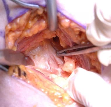 Minimally invasive total hip arthroplasty: direct 