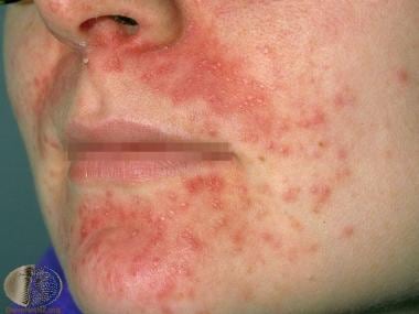 Perioral Dermatitis: Background, Pathophysiology, Etiology of