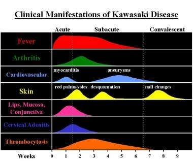 Clinical manifestations and time course of Kawasak