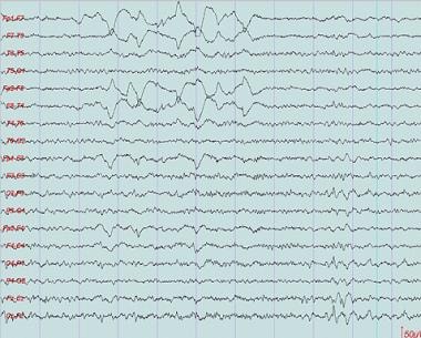 This is a good example of saw tooth waves seen in 