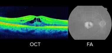 Optical coherence tomography (OCT) and fluorescein