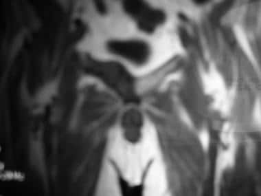 T1-weighted MRI shows low-signal-intensity lesion 