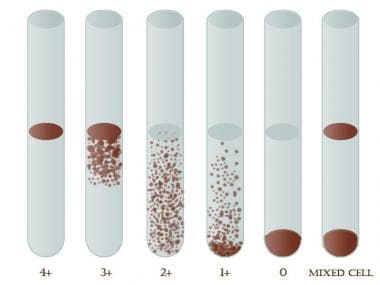 Agglutination Grading Chart