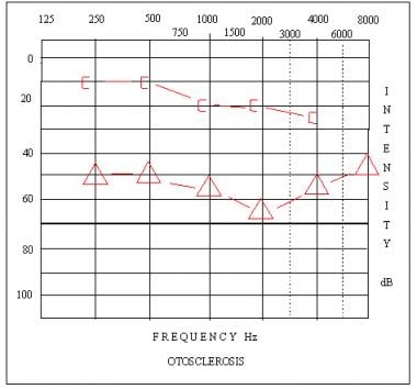 Audiogram depicting a moderate-severe conductive h