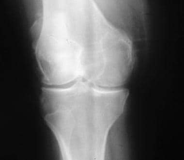 Osteoarthritis of the knee, Kellgren stage III. 