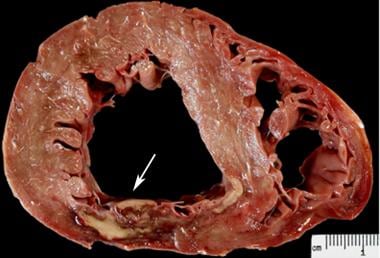 Infarction myocardial patho of Ischemic heart