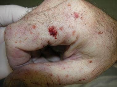Blood spatter and soot deposited on a hand that gr