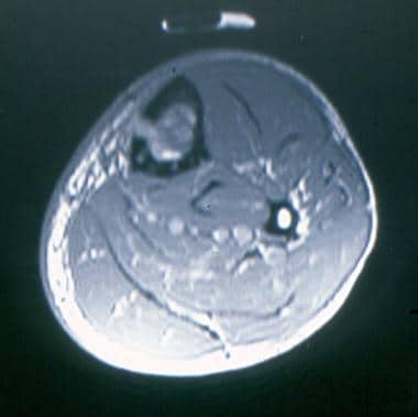 Axial T2 magnetic resonance image shows a heteroge