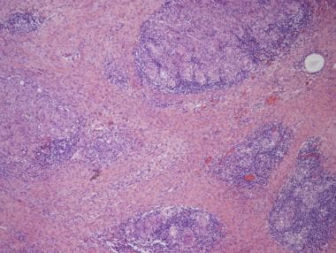 Pathology of Cystitis. Post–bacillus Calmette-Guer