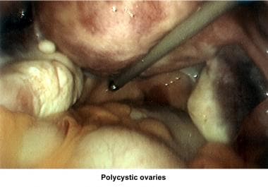 Infertility. Polycystic ovaries. Image courtesy of