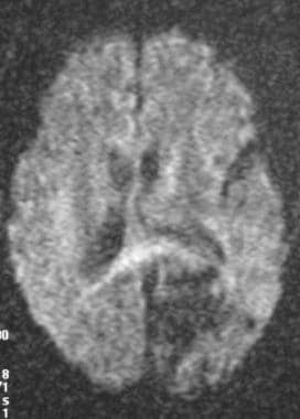 A diffusion-weighted MRI showing a lack of signal 