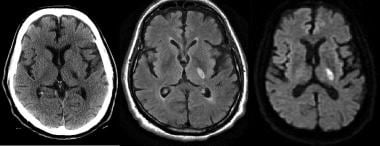 Axial noncontrast CT demonstrates a focal area of 