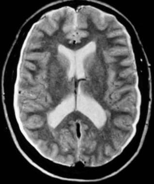Spontaneous intracranial hypotension syndrome in a