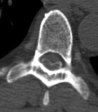 Axial CT myelogram shows a posterior central disk 