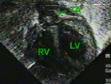 Sonogram in an infant with truncus arteriosus. Not