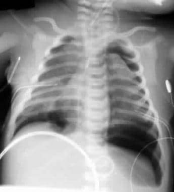 Bilateral pneumothoraces in an infant with a deep 