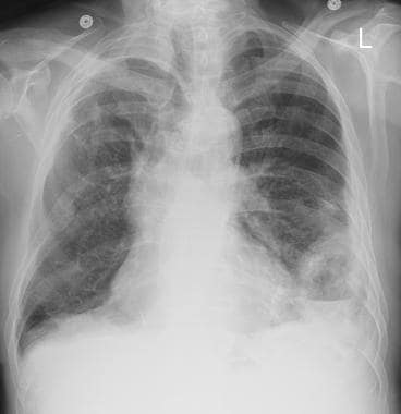 Chest radiograph obtained 6 months later in the pa