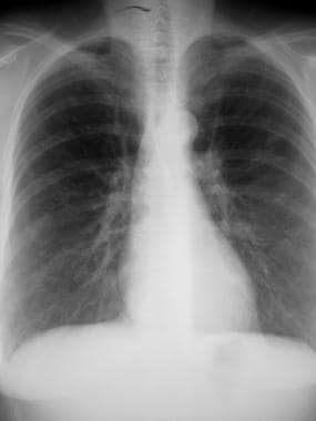 Lymphangioleiomyomatosis. Subtle interstitial reti