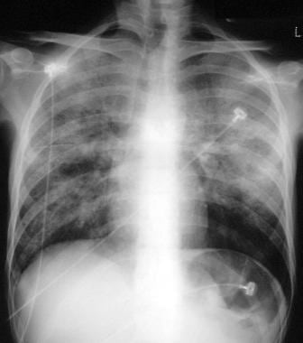 This radiograph depicts the typical bilateral air-