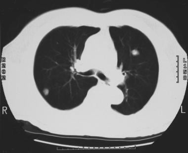 Solitary pulmonary nodule. CT scan of the thorax. 