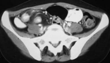 Crohn disease of the terminal ileum with CT and so