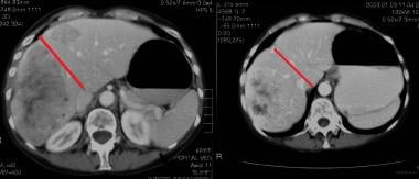 Liver, metastases. Contrast-enhanced transaxial CT