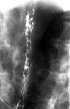 esophageal varices x ray