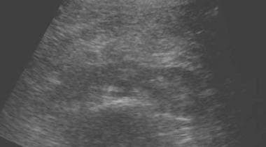 Ultrasonogram of a pediatric patient displays a hy