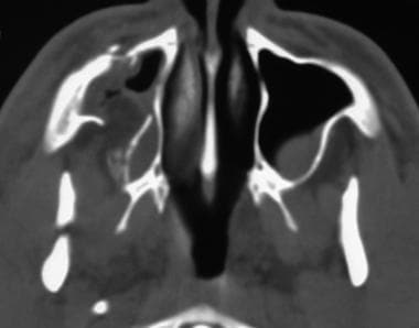 Axial computed tomography view shows a displaced b