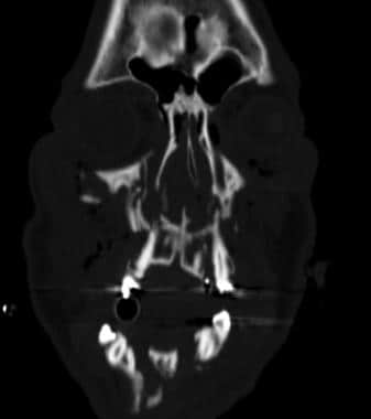 Coronal CT of a patient with right Le Fort III fra