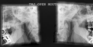 Open-mouth lateral radiographic view of both condy