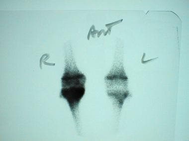 Bone scan in a 16-year-old boy complaining of pain