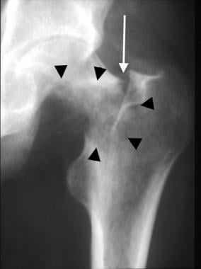 Anteroposterior radiograph of the hip in a dialysi