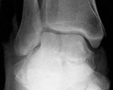 Talar body fracture, anteroposterior radiograph. T