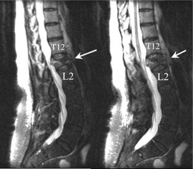 Lumbar spine trauma. Two contiguous sagittal T2-we