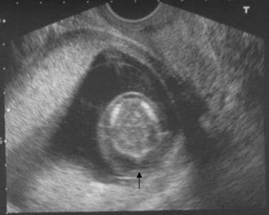 Axial prenatal ultrasonogram of a fetal head demon