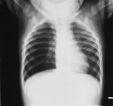 Inspiratory chest radiograph in a 12-month-old boy