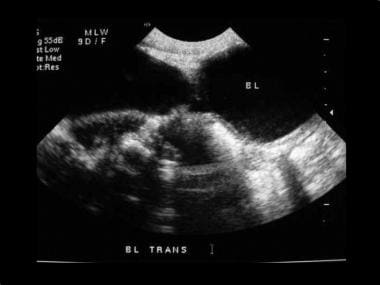 Transverse images of the right kidney demonstrate 