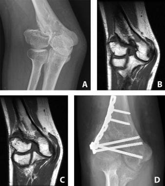 A 13-year-old youth with nonunion of lateral condy
