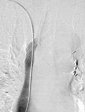 Superior vena cava syndrome (case 1, cont'd). Veno