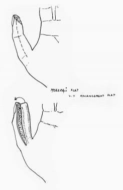 Moberg flap. 