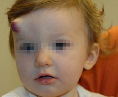 Combined superficial and deep infantile hemangioma