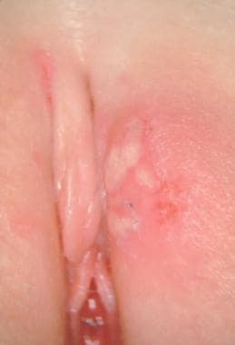 These vesicular lesions on labia majora were cultu